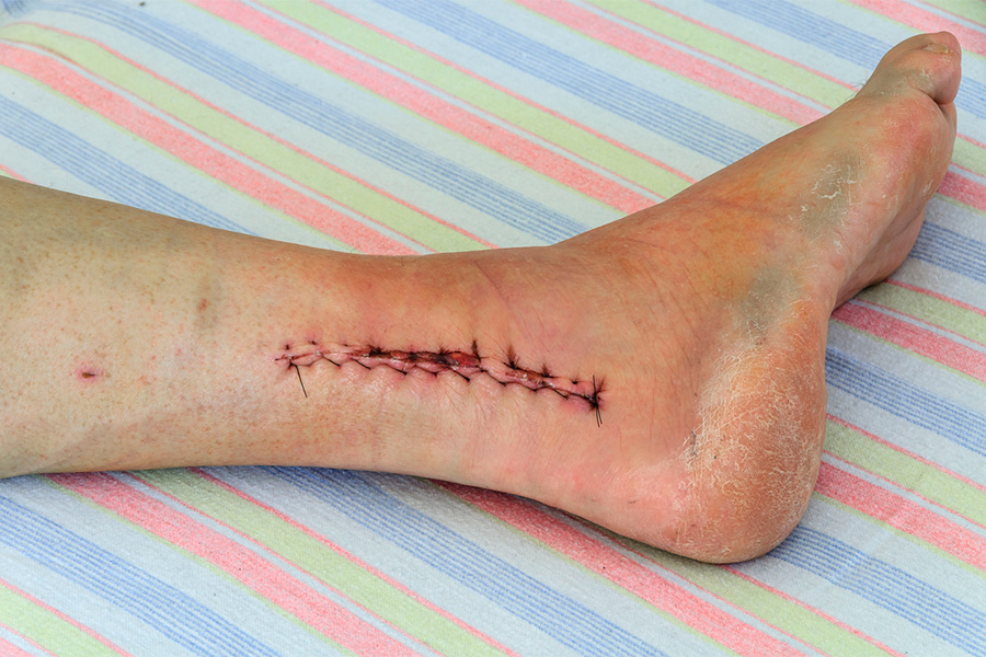 Ankle Surgery