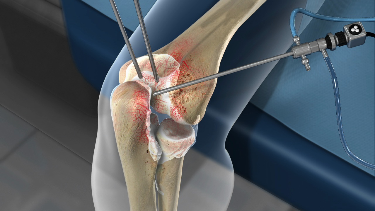 Elbow Surgery