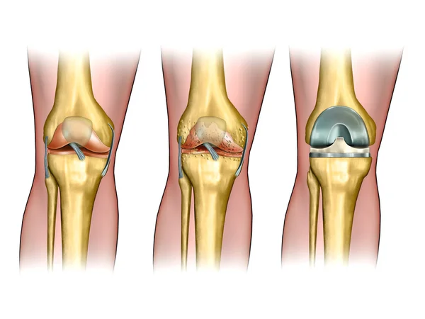 Elbow Pain in Kundalahalli