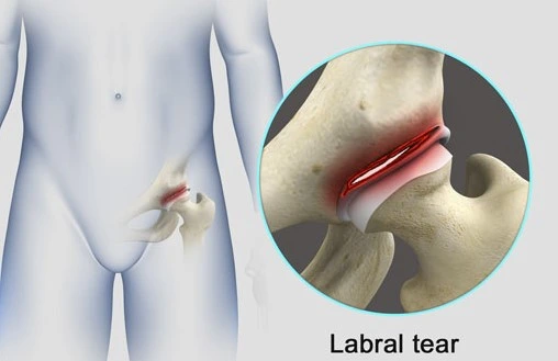  Hip Joint Pain in Kundalahalli
