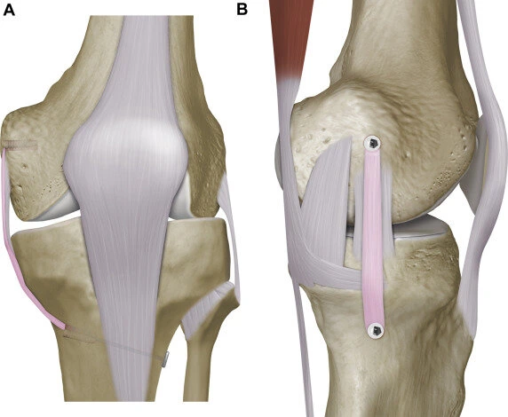 Minimally Invasive Surgery in Kundalahalli