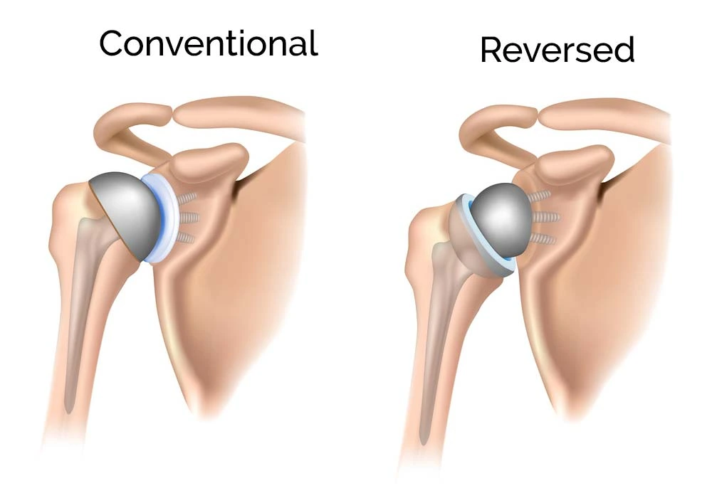 Shoulder Pain in Varthur
