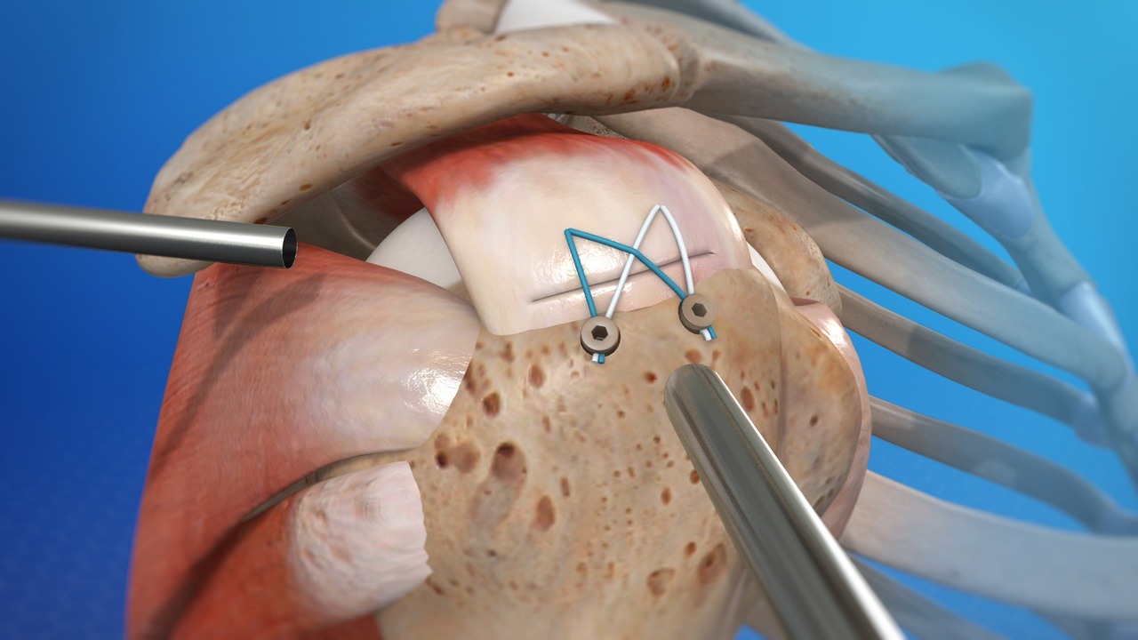Shoulder Arthroscopy