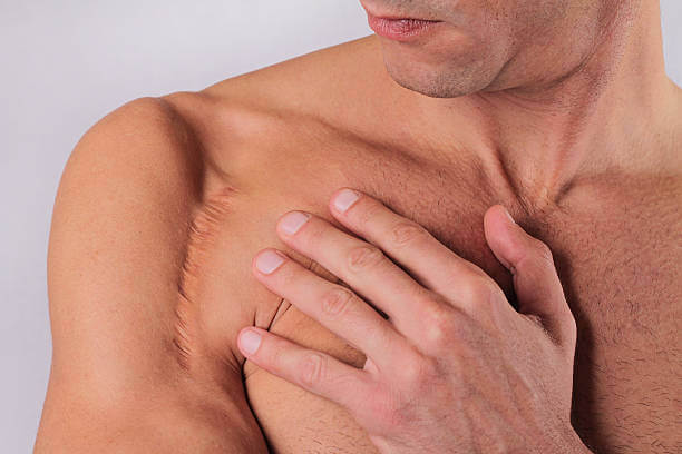Shoulder Replacement