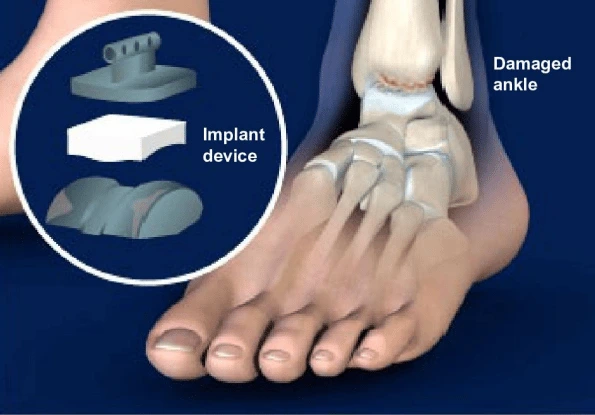  Foot & Ankle Specialist in Varthur