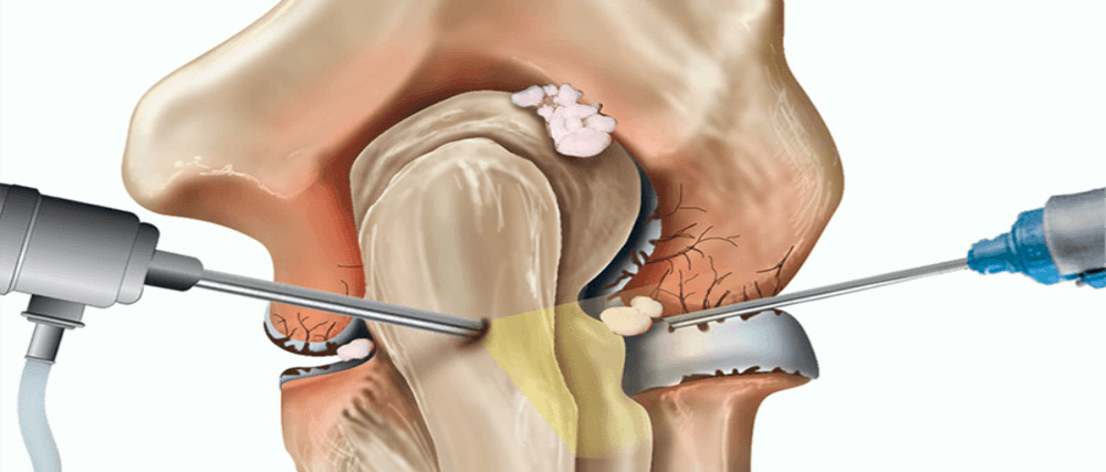 Elbow Pain in Kundalahalli