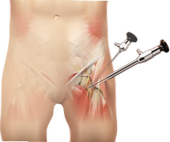 Hip Arthroscopy