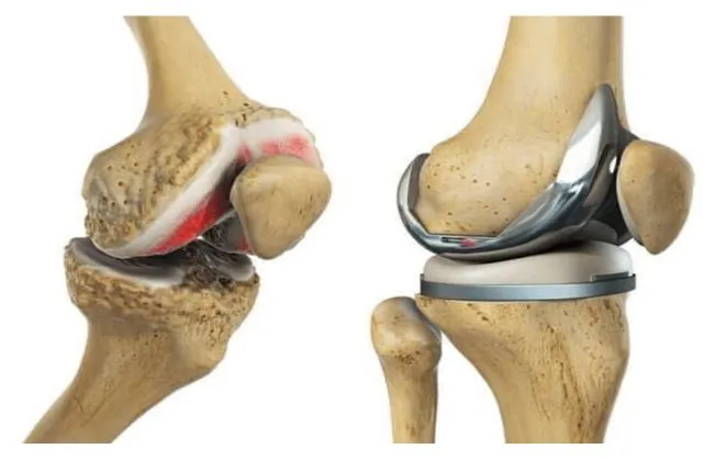Joint Pain Treatment in Varthur
